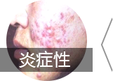 皮肤病在线咨询